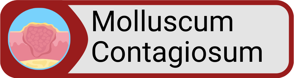 Button Molluscum Contagiosum